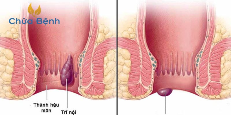 Nguyên nhân phổ biến gây nên bệnh trĩ ngoại