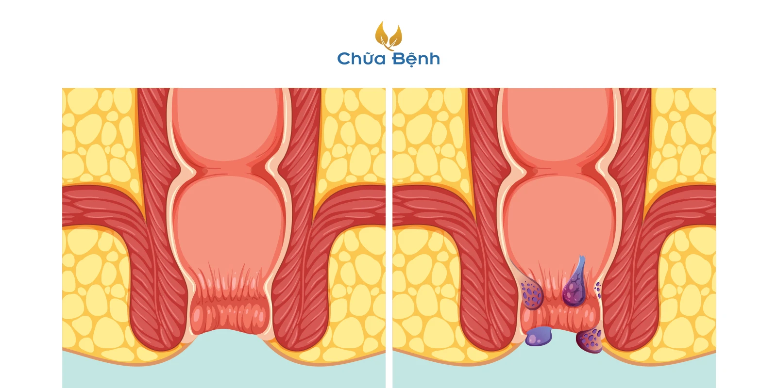 bệnh trĩ là gì 