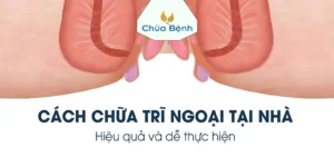 Cách chữa trĩ ngoại tại nhà