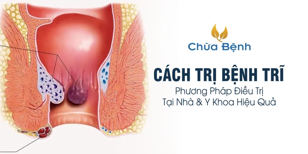 cách trị bệnh trĩ