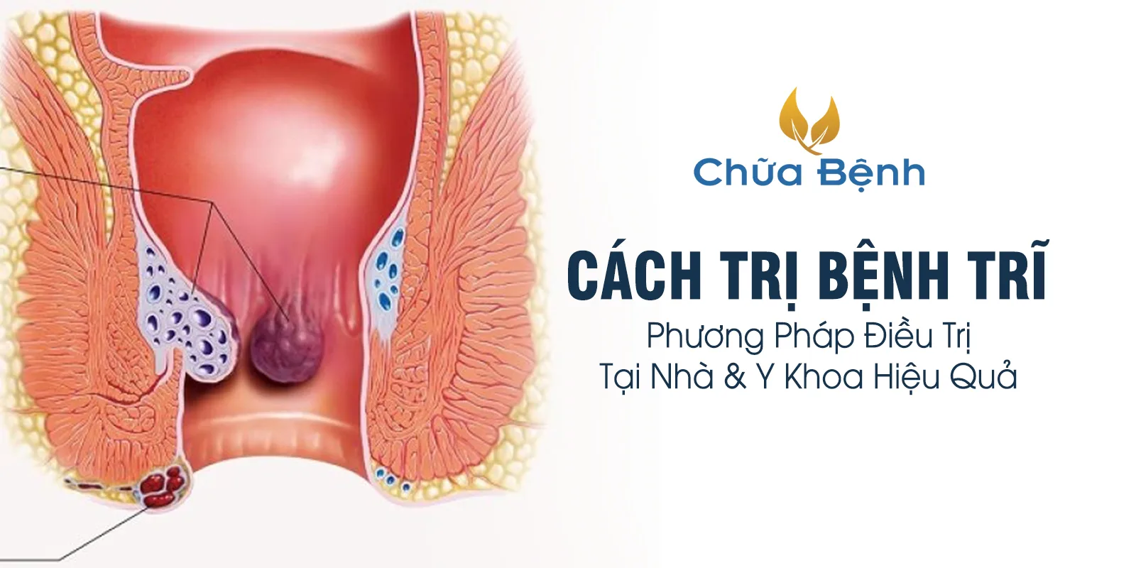 cách trị bệnh trĩ