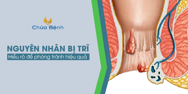 nguyên nhân bị trĩ