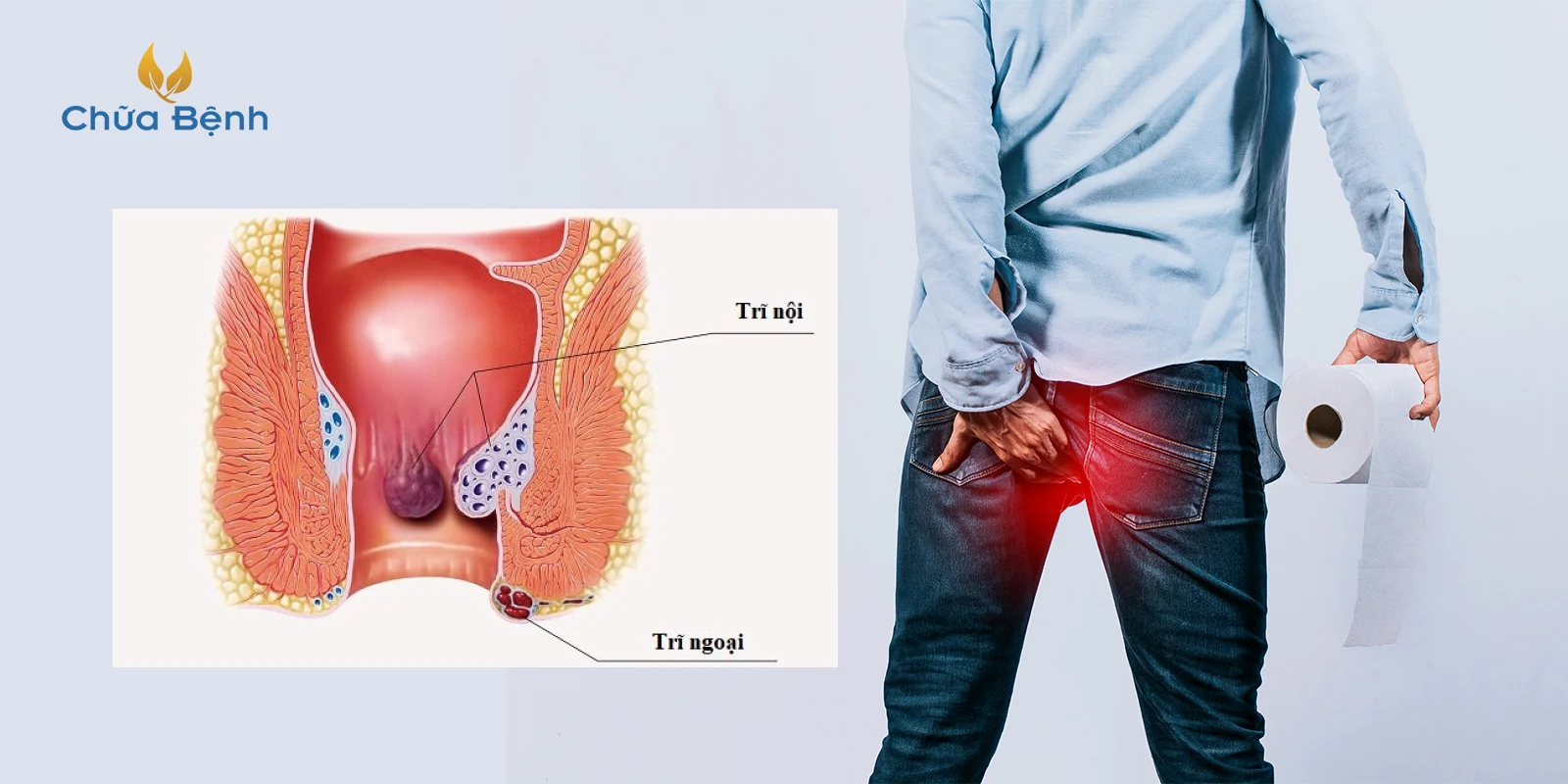 bệnh trĩ là gì 